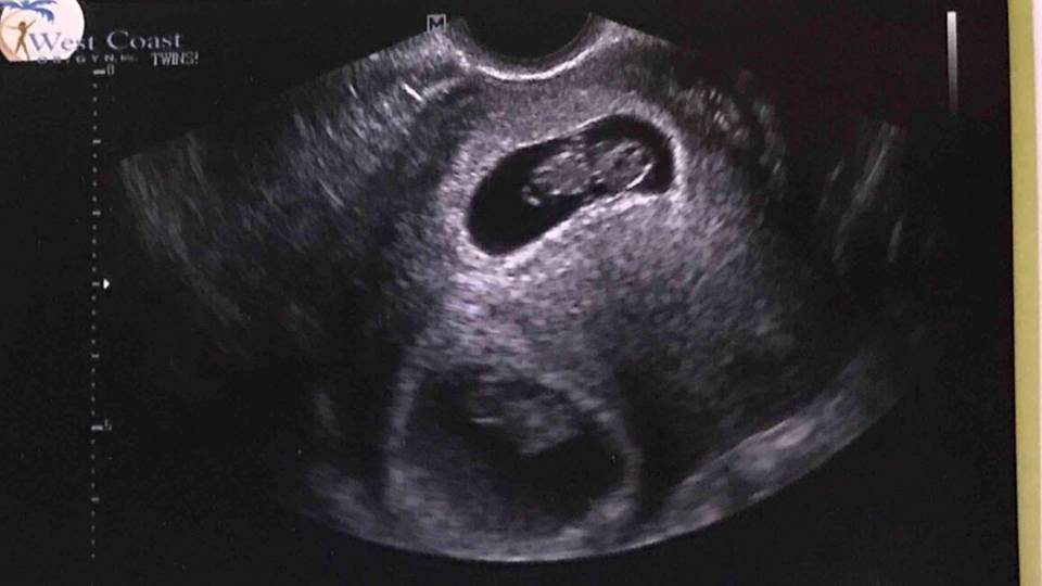 Lisa's and Nate's twins ultrasound photo