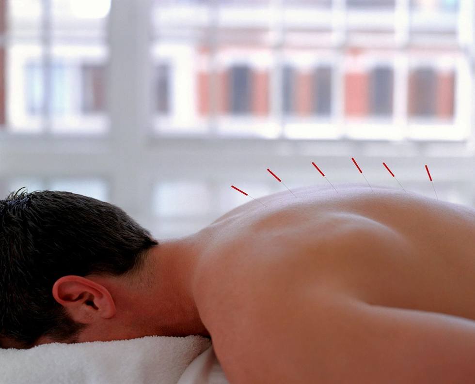 Acupuncture needles on the body